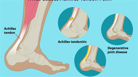 Achilles Tendinitis ⋆ Santa Barbara Deep Tissue Riktr Pro Massage Nicola Lmt