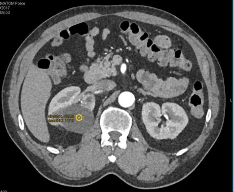 Bosniak 1 Cyst Kidney Case Studies Ctisus Ct Scanning