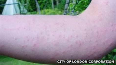 Tree Disease Threatening City Of London Bbc News