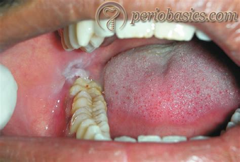 Acute Gingival And Periodontal Lesions