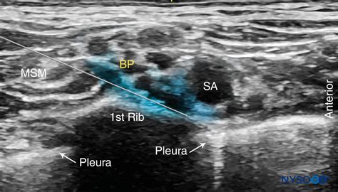 Ultrasound Guided Supraclavicular Brachial Plexus Nerve Block Nysora