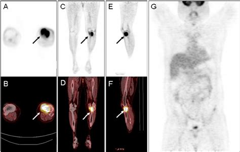 A 30 Year Old Man With Ewing Sarcoma Of The Left Proximal Tibia 7