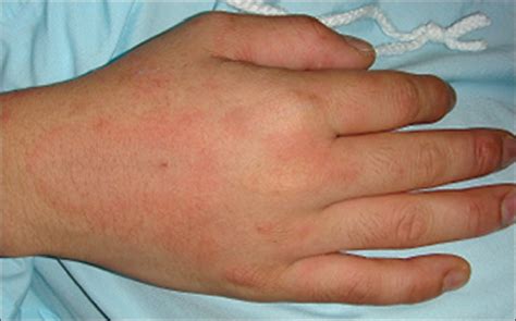 A Case Of Adult Onset Stills Disease Presenting With Urticated Plaques