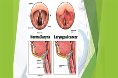 Larynx Cancer Larynx Carcinoma