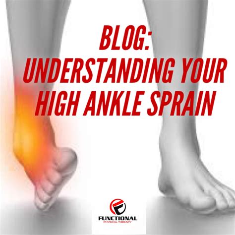 Understanding Your High Ankle Sprain