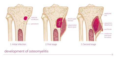 Osteomyelitis