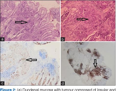 Figure 2 From Diagnostic Utility Of Endoscopic Duodenal Biopsies And