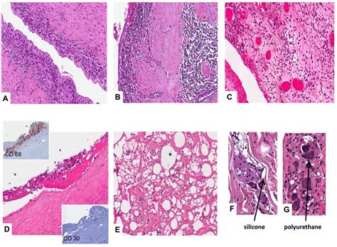Histology Of Breast Peri Implant Fibrous Capsules In Patients With