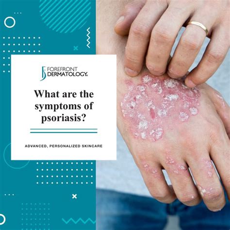 Symptoms Of Psoriasis Forefront Dermatology