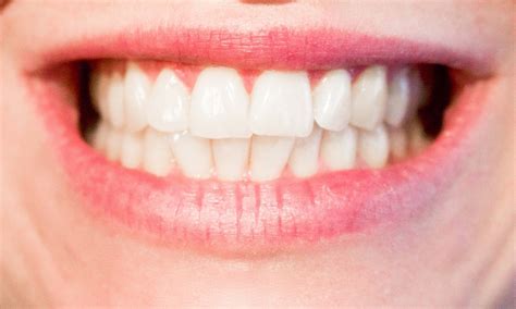 Teeth Shifting After Braces Is It Normal Your Dental Health Resource