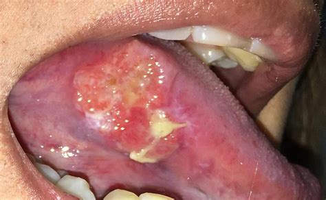 Signs Of Oral Cancer On Tongue