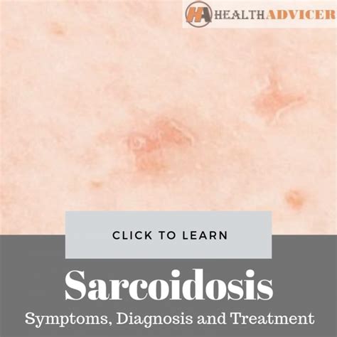 Sarcoidosis Symptoms Picture Diagnosis And Treatment
