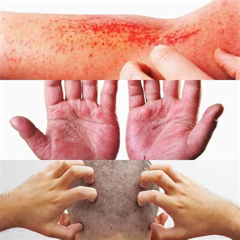 Pernah Alami Masalah Kulit Berikut 3 Jenis Dermatitis Yang Anda Patut