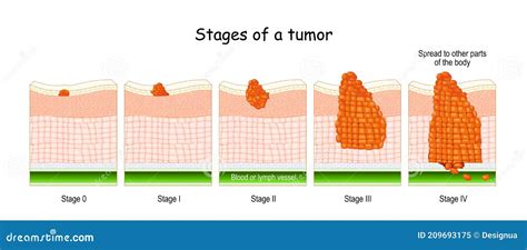 Stages Of Cancer Classification Of Malignant Tumours Stock Vector