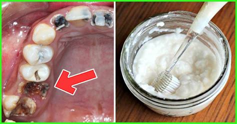 Home Remes For Removing Plaque From Teeth Homemade Ftempo