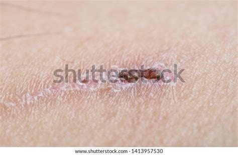 Closeup Wound Forming Scab After Skin Stock Photo 1413957530 Shutterstock