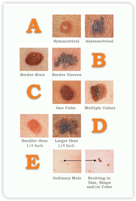 Skin Cancer Stage 4 Melanoma Cancerwalls