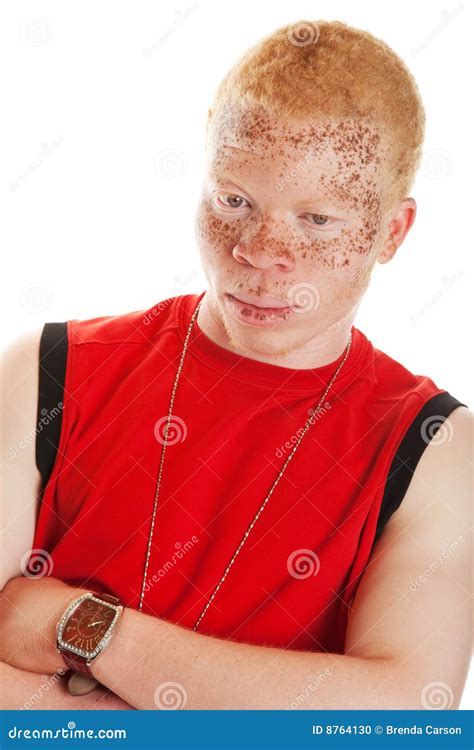 Albino Human