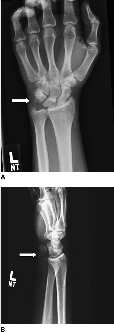 Acute Calcific Tendinitis Of The Wrist Journal Of Emergency Medicine