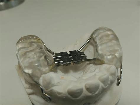 Disyuntor McNamara con ganchos para tracción maxilar Aparatos de ortodoncia Ortodoncia