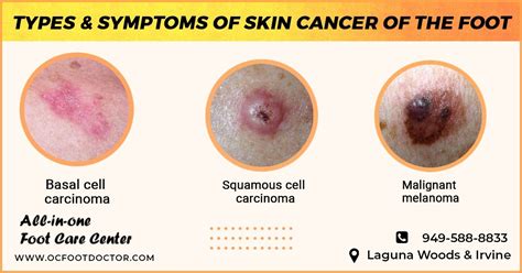 Skin Cancer Of The Foot