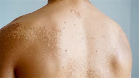 Premium Photo Peeling Skin On Human Back After Excessive Summer Sun