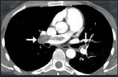 tep agudo em paciente do sexo feminino 49 anos imagem de tc em download scientific diagram