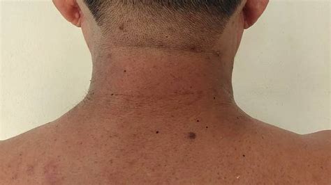 130 Acne On A Males Shoulder Stock Photos Pictures And Royalty Free