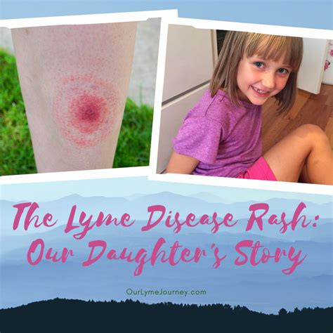 Lyme Disease Awareness Lymes Three Stages Never Alone