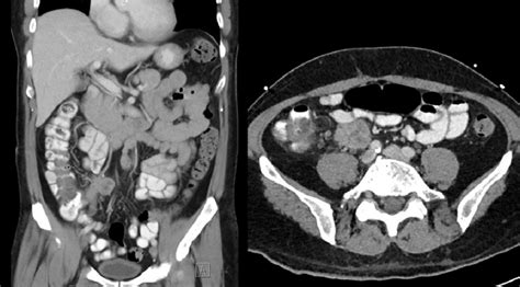 Post Contrast CT Abdomen Showing Peri Appendicular Abscess