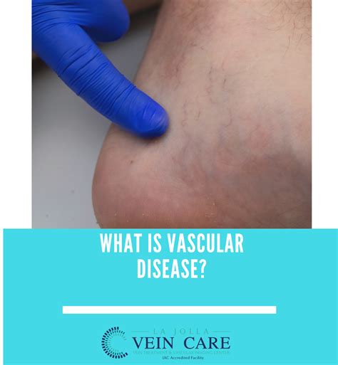 Vein And Vascular Treatment Vein And Vascular Care Clinic La Jolla Ca