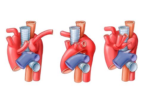 Right Aortic Arch With Aberrant Left Subclavian