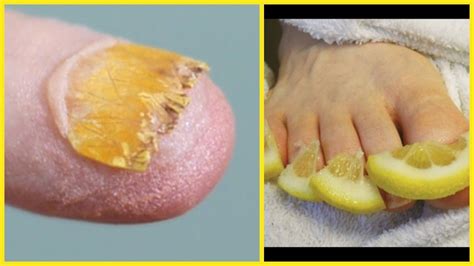 Best Natural Home Remedies For Nail Fungus That Really Works Natural