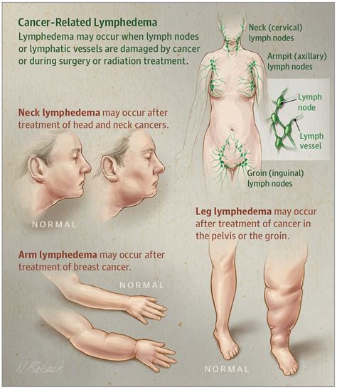This Patient Page Provides Information Of Lymphedema A Condition Caused By Lymph System
