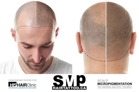What Is Scalp Micropigmentation Hair Tattoo ️hairtattooca