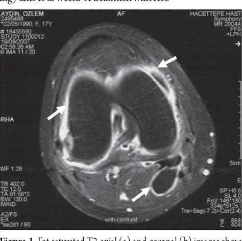 Figure 1 From Ruptured Bakers Cyst In Juvenile Idiopathic Arthritis A