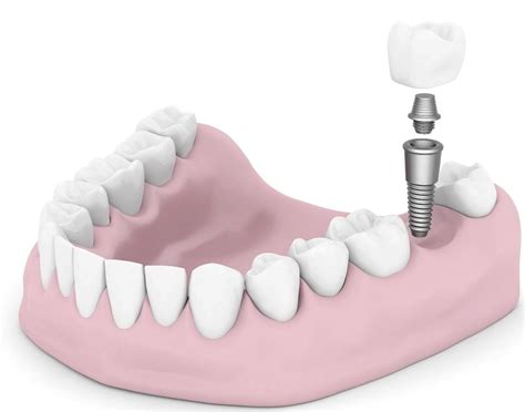 Edmond Dental Center Blog The Best Permanent Tooth Replacement Option
