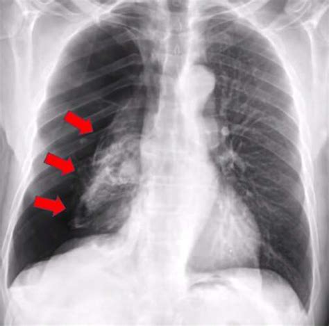 Ai System More Accurately Identifies Collapsed Lungs Using Chest X Rays