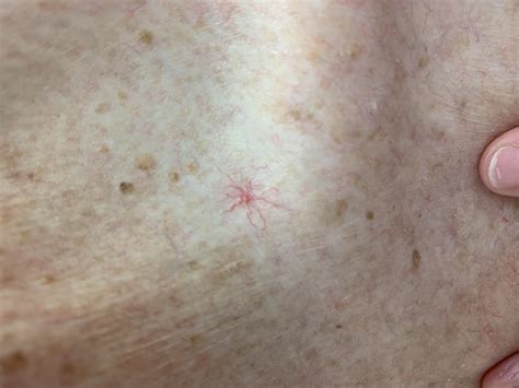 Spider Angioma Appalachian Spring Dermatology