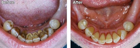 Ultrasonic scaling instruments clean plaque from the teeth with a vibrating metal tip that chips off the tartar and a water spray to wash it away and. Gum Disease Gallery - Dr. Jack M. Hosner, D.D.S.
