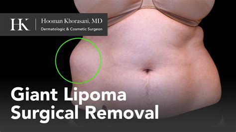 How To Remove A Giant Lipoma Of The Abdomen Dr Hooman Khorasani YouTube