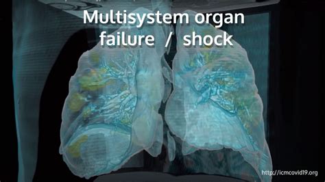Multisystem Organ Failure Shock