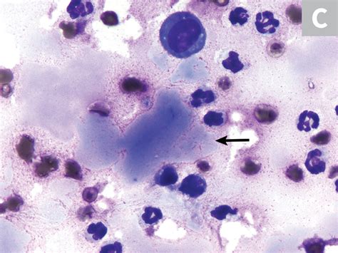 Effusion Cytology Clinicians Brief