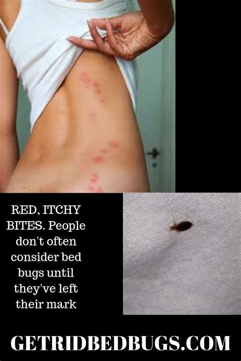 Bed Bug Bites Vs Scabies Home Decor