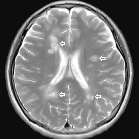 Gadolinium Contrast Brain Magnetic Resonance Imaging Mri Imaging