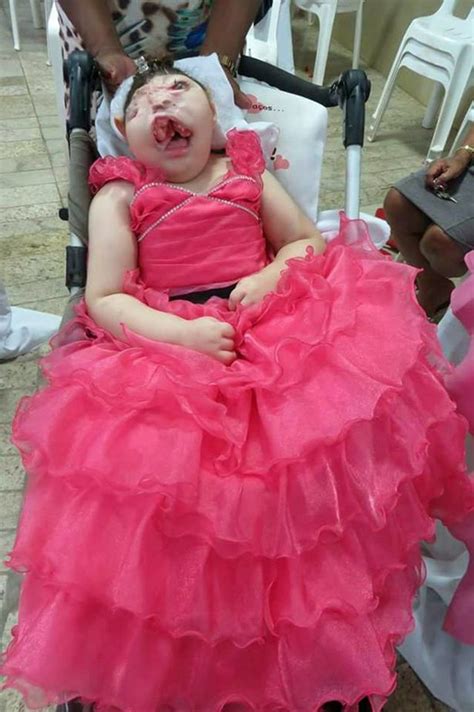 Girl Born Without A Face Expected To Die Within Hours Defies The Odds