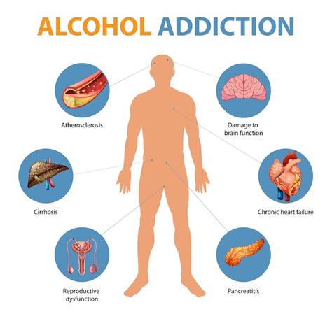 Alkoholabh Ngigkeit Symptome Infografik Kostenlose Vektor