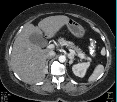 Recurrent Renal Cell Carcinoma Metastatic To The Pancreas