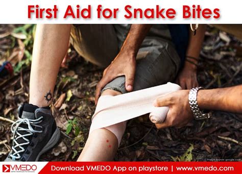 First Aid For Snake Bites VMEDO Blog