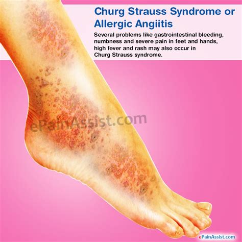 Churg Strauss Syndrome Diseases Signs And Symptoms Symptoms Treatments
